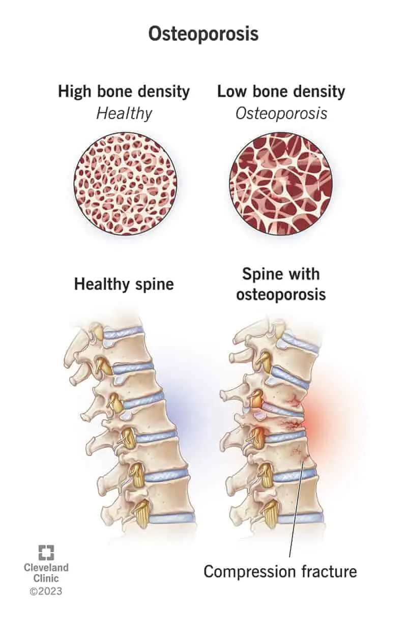 Osteoporosis-book